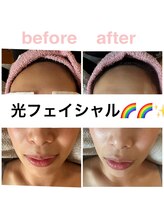 アルーア(Allure)/光フェイシャルbefore after