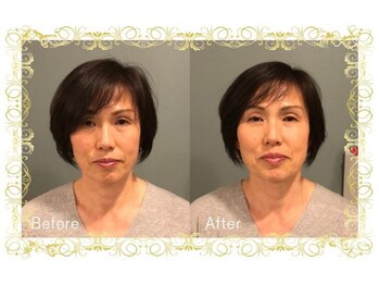 レメディ/再生美容鍼コース