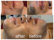 MMA/プレミアム光脱毛【ひげ】