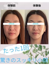 エノア(ENOA)/豊橋/輪郭矯正小顔コルギ