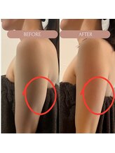 美容痩身ラボ 松山院/施術経過（冷却・レモンボトル）