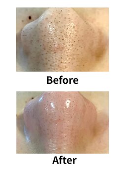 サロンリアンジュ ひたちなか店(Salon Liange)/◇毛穴洗浄◇ハイドロスキン◇