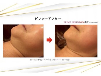 シュシュルーム 前橋店の写真/40代以降、写真に写った時の二重あごが気になる方へ。