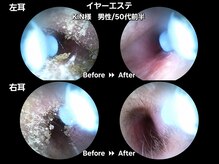 ツバキ 岐阜店(TSUBAKI)/【1】イヤーエステbefore→After