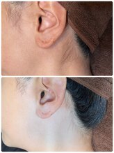 ノノ(nono)/もみあげ～うなじ脱毛