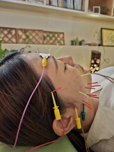 薄桜樹/トライアル美容鍼