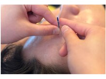 4515/髪の毛ほどの細い鍼を使用