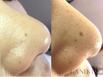 キャンディ 難波心斎橋店(CANDi)/ハイドラピーリング/黒ずみ毛穴