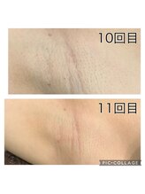 レイモード(Ray mode)/全身脱毛(顔あり)高校生