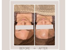 ミルトゥ(myrte)/Before→After 乾燥肌ケア