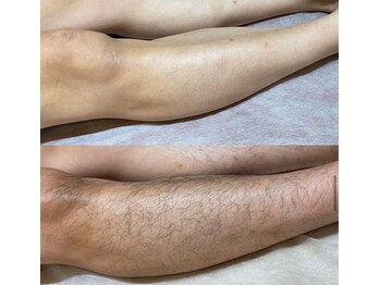 ロンド(Lond)/メンズ足まるごと脱毛!