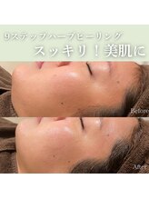 ハーブのほし/剥けないハーブピーリング