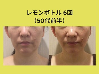 アユアラングレース/レモンボトル6回