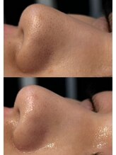 #美容革命ラボ 大阪南堀江店 毛穴洗浄 激変