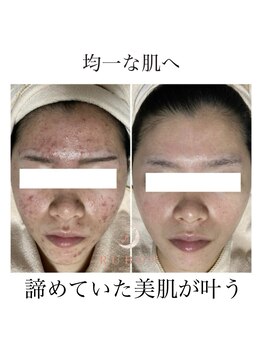 ルボン 宮崎店(RUBON)/ニキビケア症例