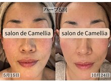 サロンドカメリア(salon de Camellia)の雰囲気（エルモサハーブで土台からお肌を整えます。トラブル知らずの肌へ）