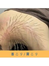 いつつのき/ルート鍼