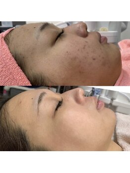 素肌新館 御殿場店/before after：肌トラブルケア