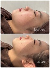 ツール(TOOL)/ハーブピーリング