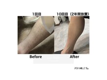 パーミル 千里丘店(per mille‰)/本店の足脱毛結果