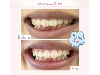 エクシアホワイトニング 調布店/20代男性会員様/1回目