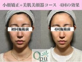 キュープ 福岡九大学研都市店(Qpu)/美顔器モニターコース４回の変化