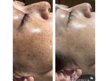 ラズ(Luz)/シミケア