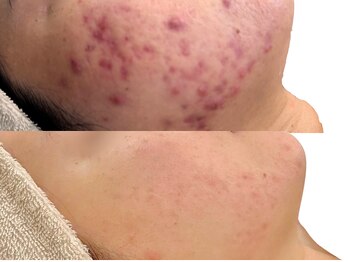 ニコレ(Nicore)/ニキビケア×ホームケア