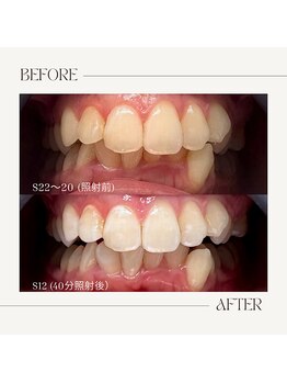ホワイトニングビューティー 鯖江店(WHITENING BEAUTY)/初回40分照射コース