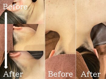 ルナステラ 七尾店/LEDローズ脱毛