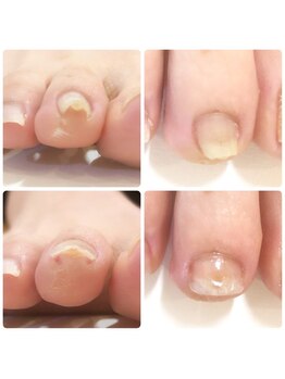 プレシオサ ネイル(Preciosa Nail)/小さい指も地味に痛い巻き爪