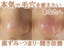 ストック(stock)/本気で毛穴をかえたいあなたへ
