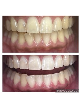 エクシアホワイトニング 郡山店/ホワイトニングビフォーアフター