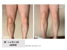 ビープランニング(B-PLANNING.)/【メンズ脱毛、4回で実感】