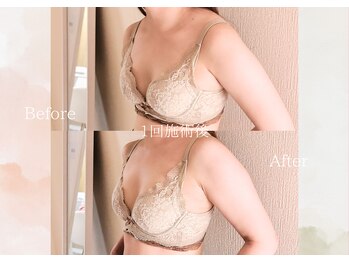 ルナ 千葉(LUNA)/1回施術後