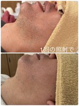 ティアレ 廿日市店(Tiare)/髭　脱毛　ビフォーアフター