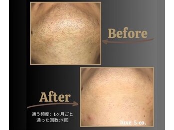リュクスアンドコー 上田店(Luxe&co.)の写真/メンズ脱毛★【顔全体/ヒゲ脱毛(首・おでこ付き)¥4900】上田駅近◎お得なクーポンも多数ございます!
