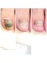 プレシオサ ネイル(Preciosa Nail)/変形爪　1本