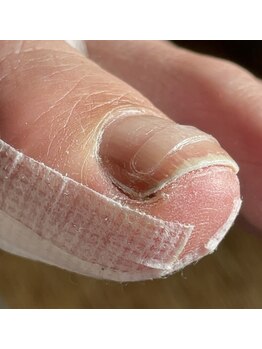 ラウレア(Laule'a)/巻爪矯正/BSスパンゲプレート