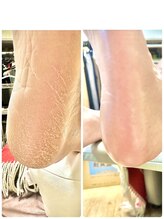 ボンド(The bond)/角質ケア【フットケア　玉造】