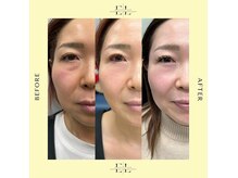 ベルシック(Belchic)の雰囲気（プラズマ搭載でより即効性と持続性をシワたるみ改善）