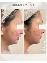 ひっそり美肌構築/横顔スッキリ！