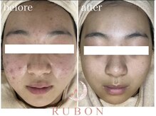 トータルビューティサロン ルボン(RUBON)/ニキビケア症例