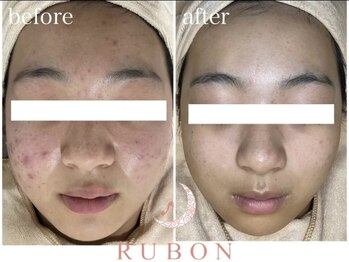 トータルビューティサロン ルボン(RUBON)/ニキビケア症例