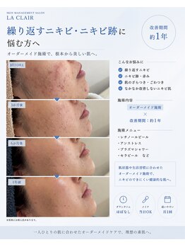 ラ クレール ビューティーサロン(LA CLAIR)の写真/韓国美容で話題の《セラピール》が上陸!!本場韓国の肌管理を再現◎《高濃度レチノールピール》もおすすめ!