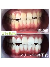 ルブラン 奈良店(Le Blanc)/劇的に白く変身！１