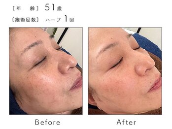 チップ(chip)/51歳/施術1回