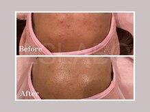 エスラボ オオサカ 心斎橋/本気の肌質改善