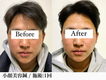 フラット(flat)/美容鍼で小顔リフトアップ