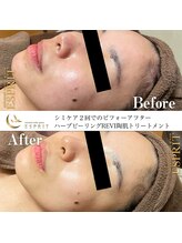 エスプリ 銀座店/ハーブピーリング銀座